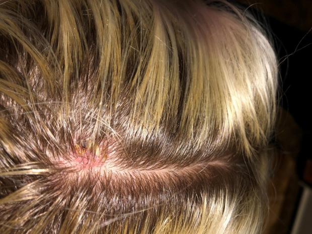 Skin Cancer On Scalp Photo Warning From Head Rush Hairdresser