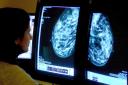 More than 20,000 Cornwall women miss breast cancer screening