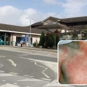 An emergency department consultant at the Royal Cornwall Hospital has given advice about Strep A and scarlet fever